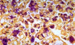 Gridley Fungus (GF) Stain